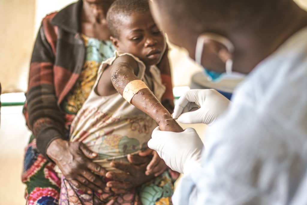 RDC : fin officielle de l’épidémie de Mpox (Gouvernement)